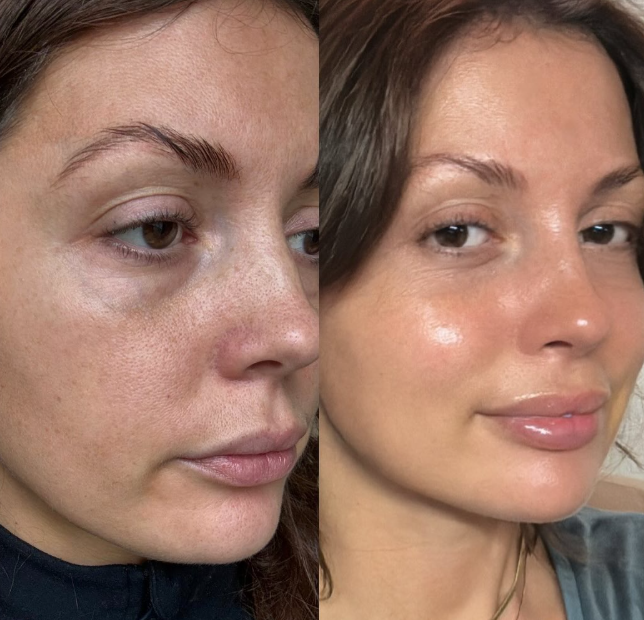 MY|Nutra Glow skin supplements for 6 weeks